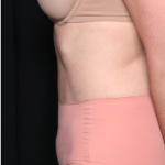 Tummy Tuck Before & After Patient #34348